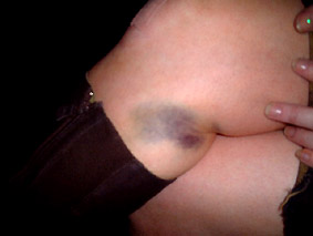 :: mystery bruises ::